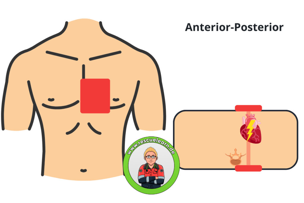 Anterior-Posterior Positionierung der FAST-Patches