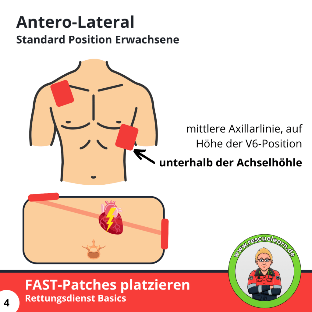 Antero-Lateral Standard Position Erwachsene