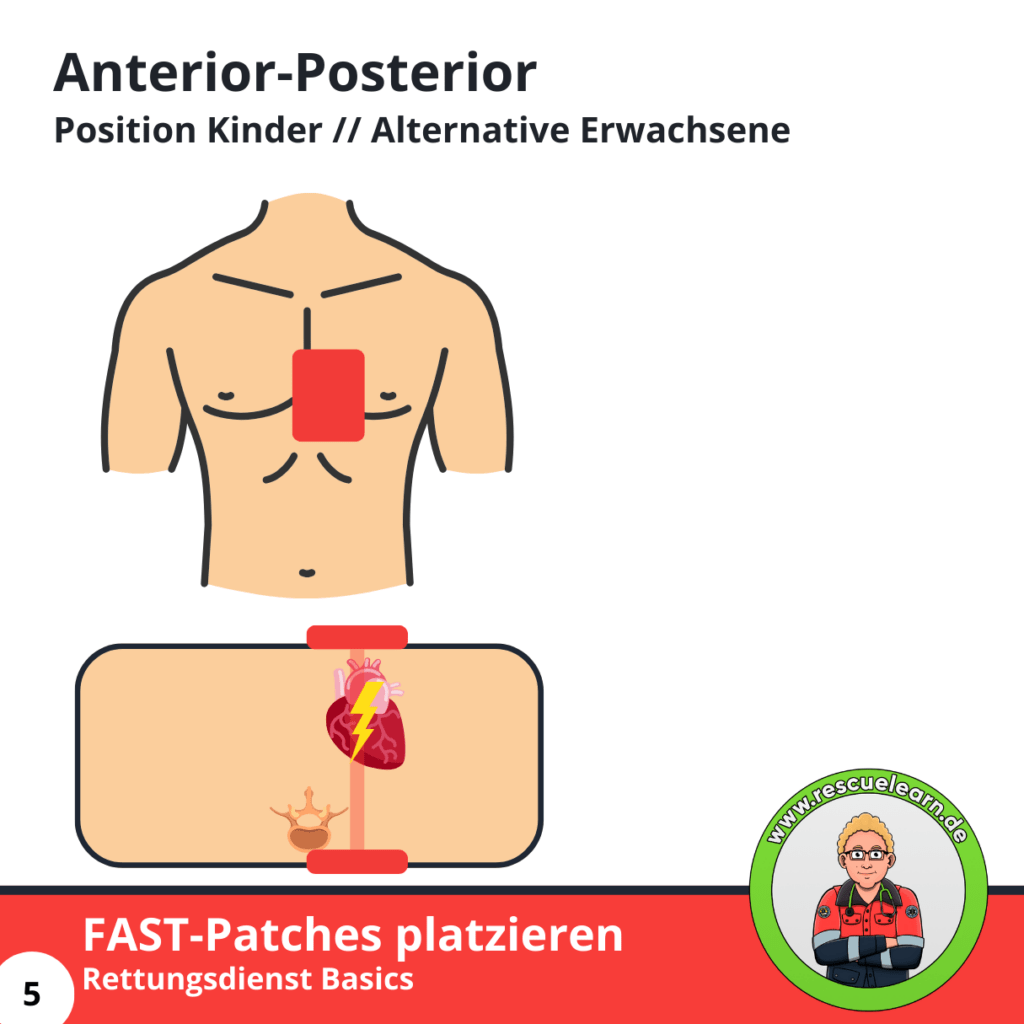 Anterior-Posterior Alternative Positionierung