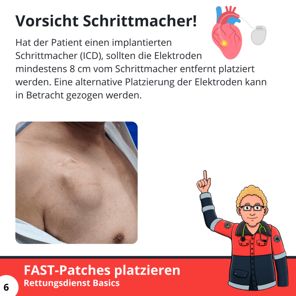 Vorsicht Schrittmacher!