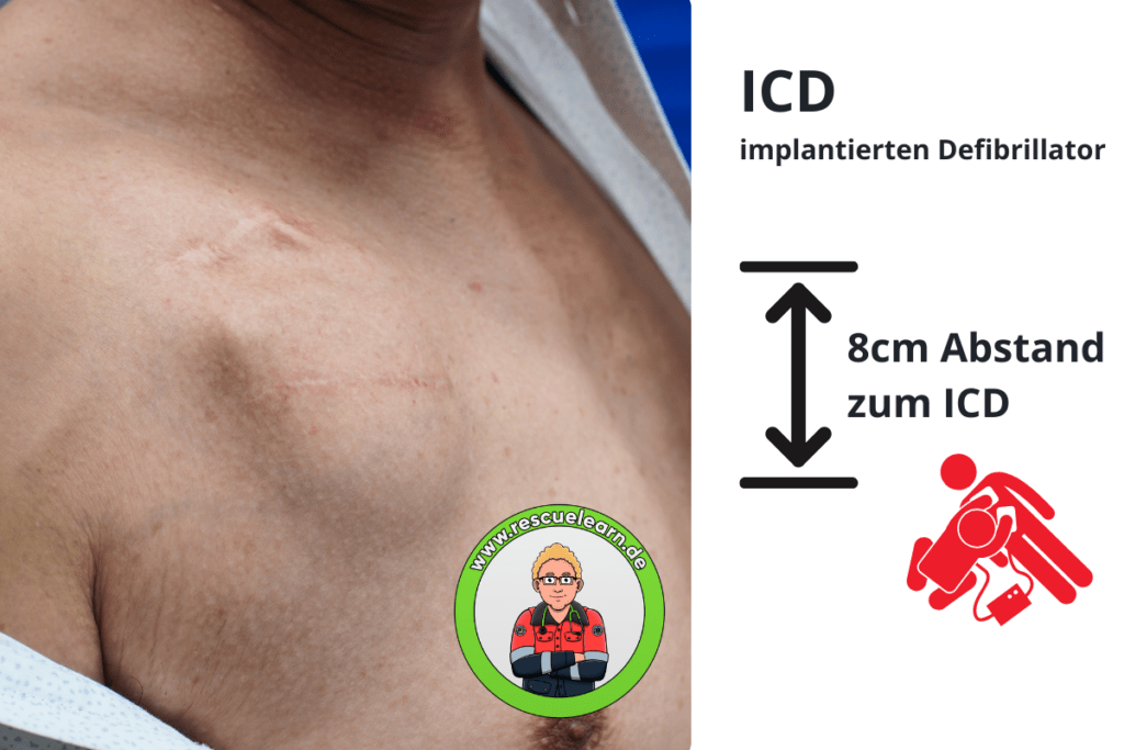 Defibrillationselektroden platzieren