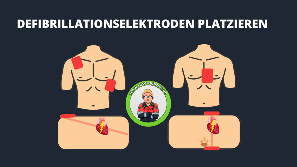 Defibrillationslektroden richtig platzieren